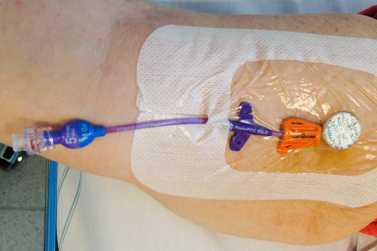 Här syns en så kallad ”picc-line”, en ingång till blodkärlet på överarmen.