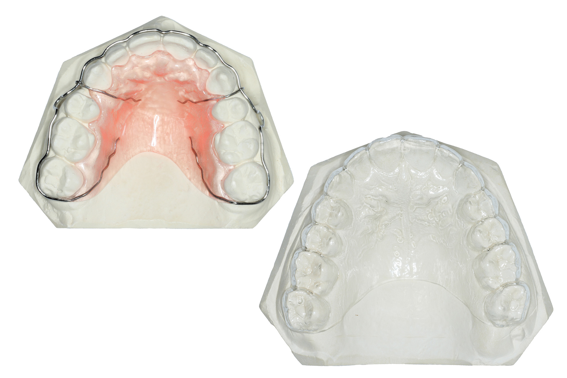 En gipsavgjutning som visar en avtagbar trådställning fastsatt i tänderna, och en gipsavgjutning som visar en avtagbar hållare i plastmaterial..